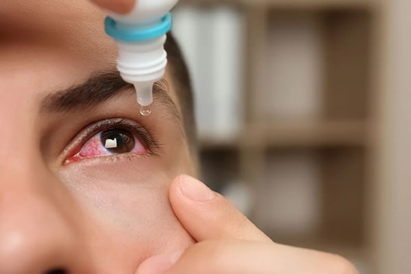 انواع برق‌زدگی چشم در جوشکاری
